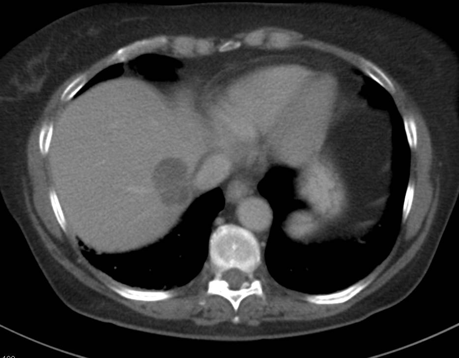 Hepatic Abscess - CTisus CT Scan