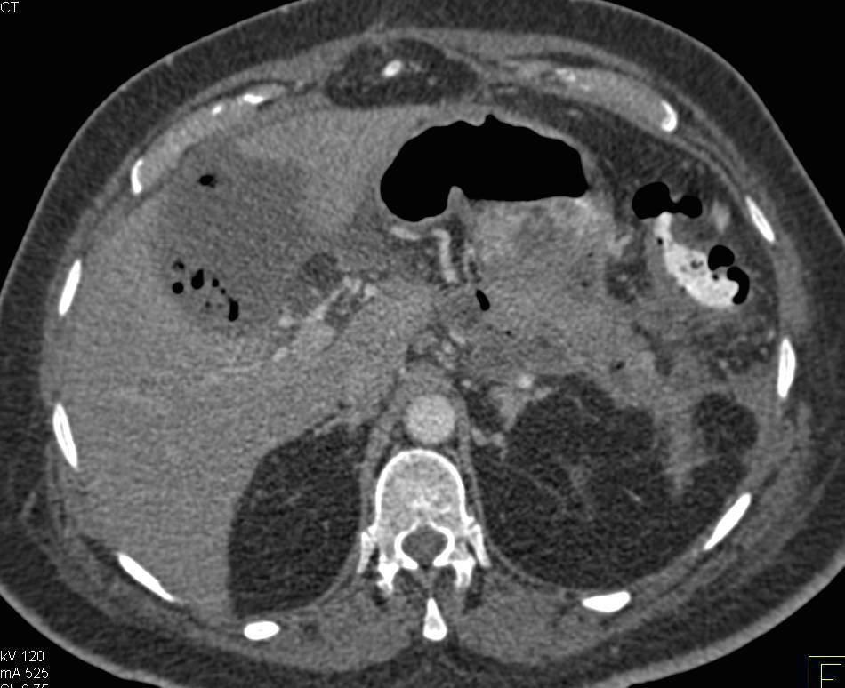 Gallbladder Abscess - CTisus CT Scan
