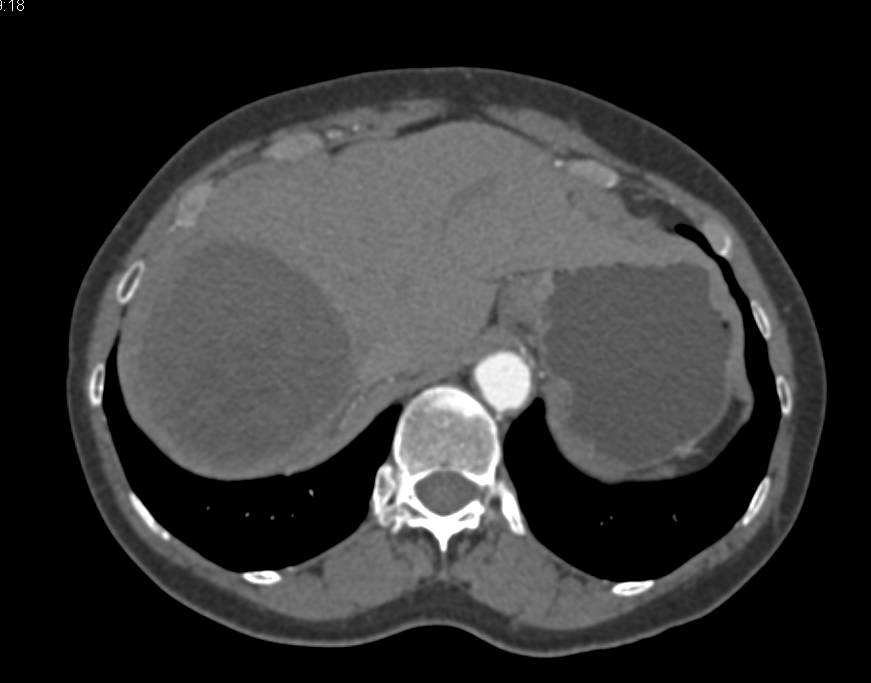Hydatid Cyst in the Liver-See Additional Cyst or Daughter Cysts - CTisus CT Scan