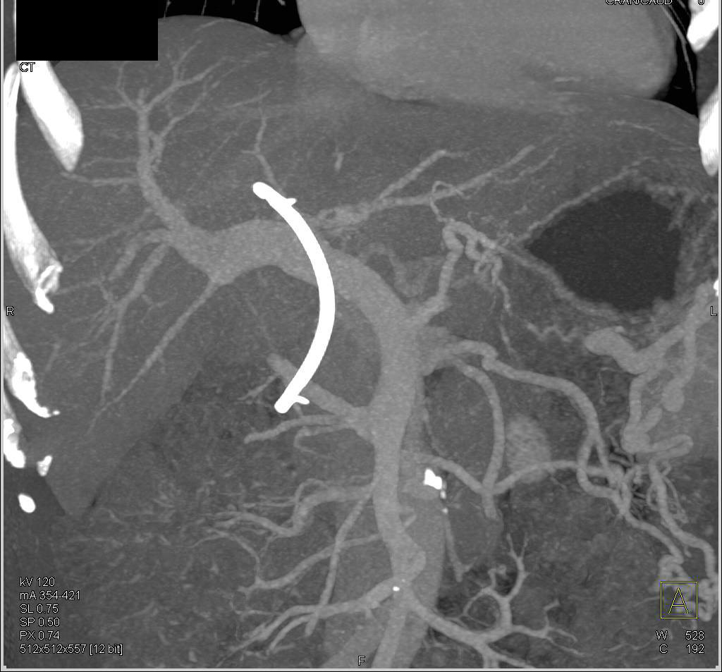 Klatskin Tumor Infiltrates and Obstructs the Common Bile Duct - CTisus CT Scan