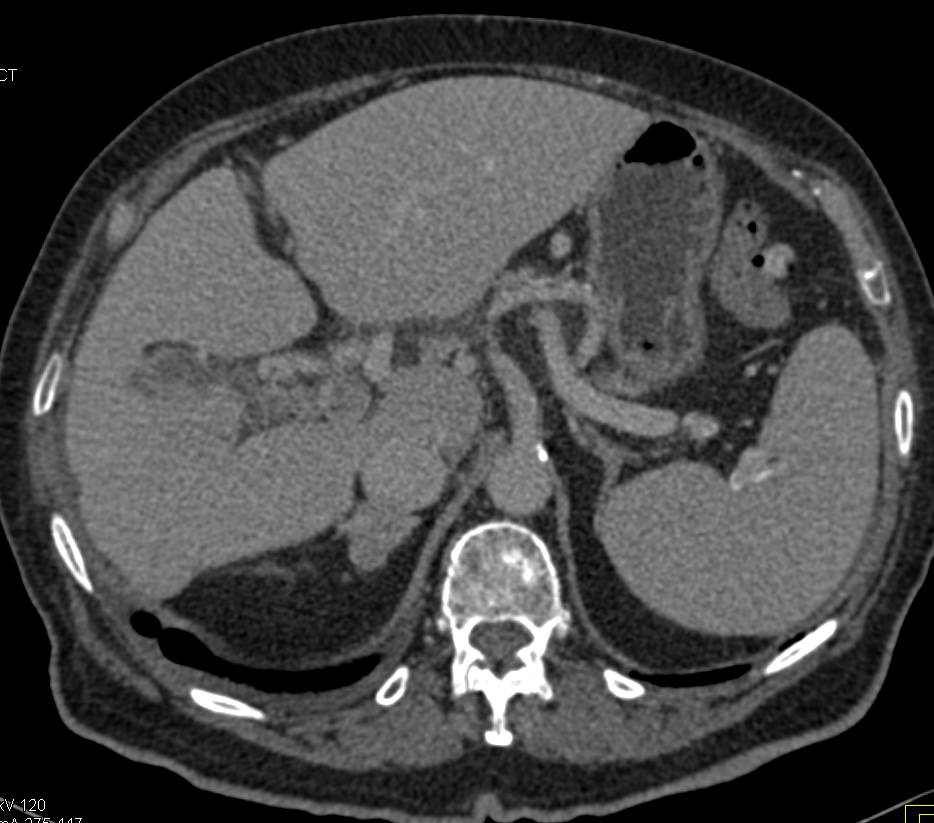 Cirrhosis with Thrombus in the Portal Vein - CTisus CT Scan