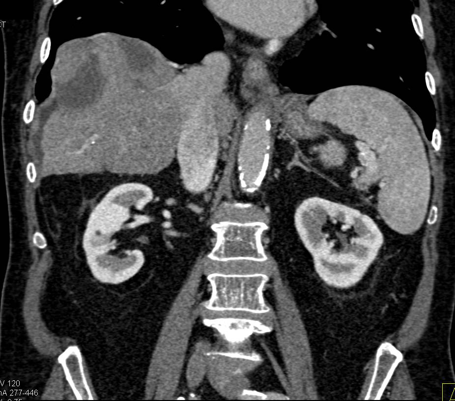 Hepatocellular Carcinoma (Hepatoma) Invades the Portal Vein with Collaterals - CTisus CT Scan