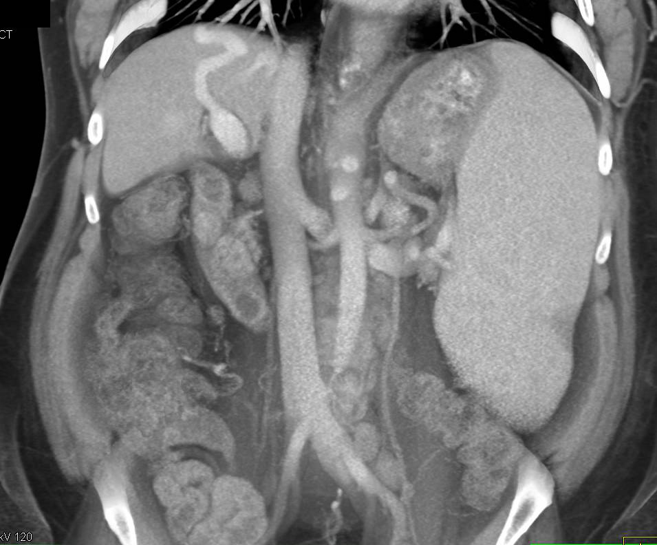Cirrhosis with Portal Hypertension and Hepatic Vein-Portal Vein Fistulae - CTisus CT Scan