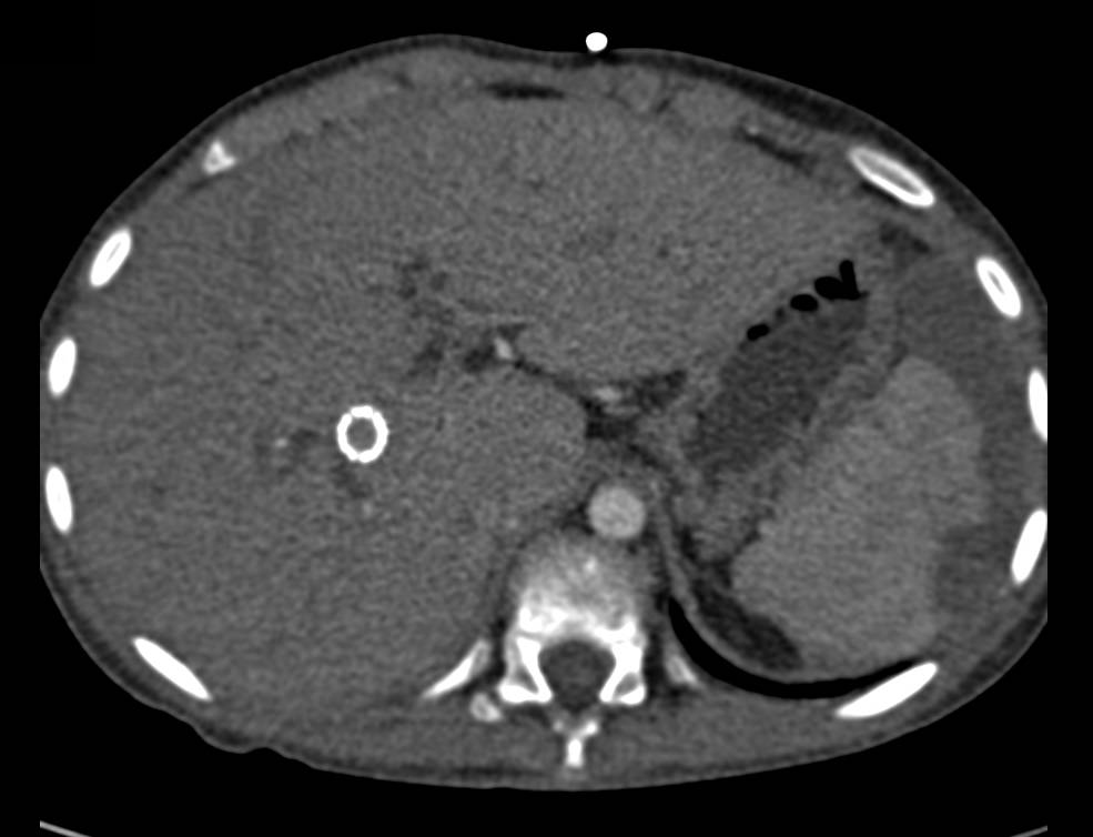 Cirrhosis with Transjugular Intrahepatic Portosystemic Shunt (TIPS) and Splenic Infarcts and Portal Hypertension - CTisus CT Scan