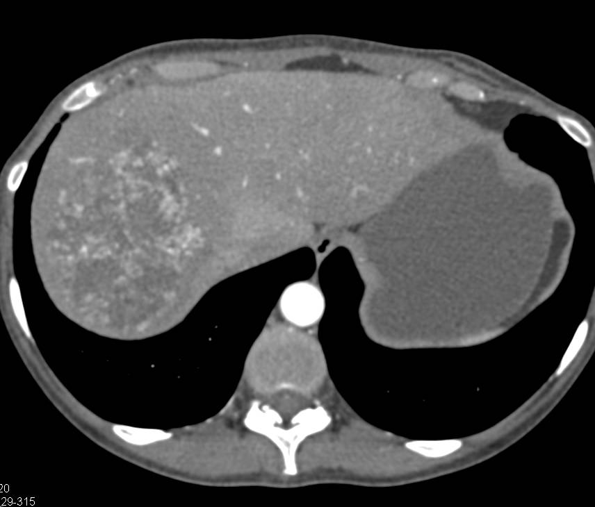 Angiosarcoma of the Liver - CTisus CT Scan