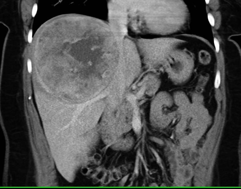Hepatocellular Carcinoma (Hepatoma) with Neovascularity - CTisus CT Scan