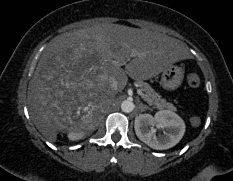 Hepatocellular Carcinoma (Hepatoma) with Neovascularity and Pseudocapsule - CTisus CT Scan