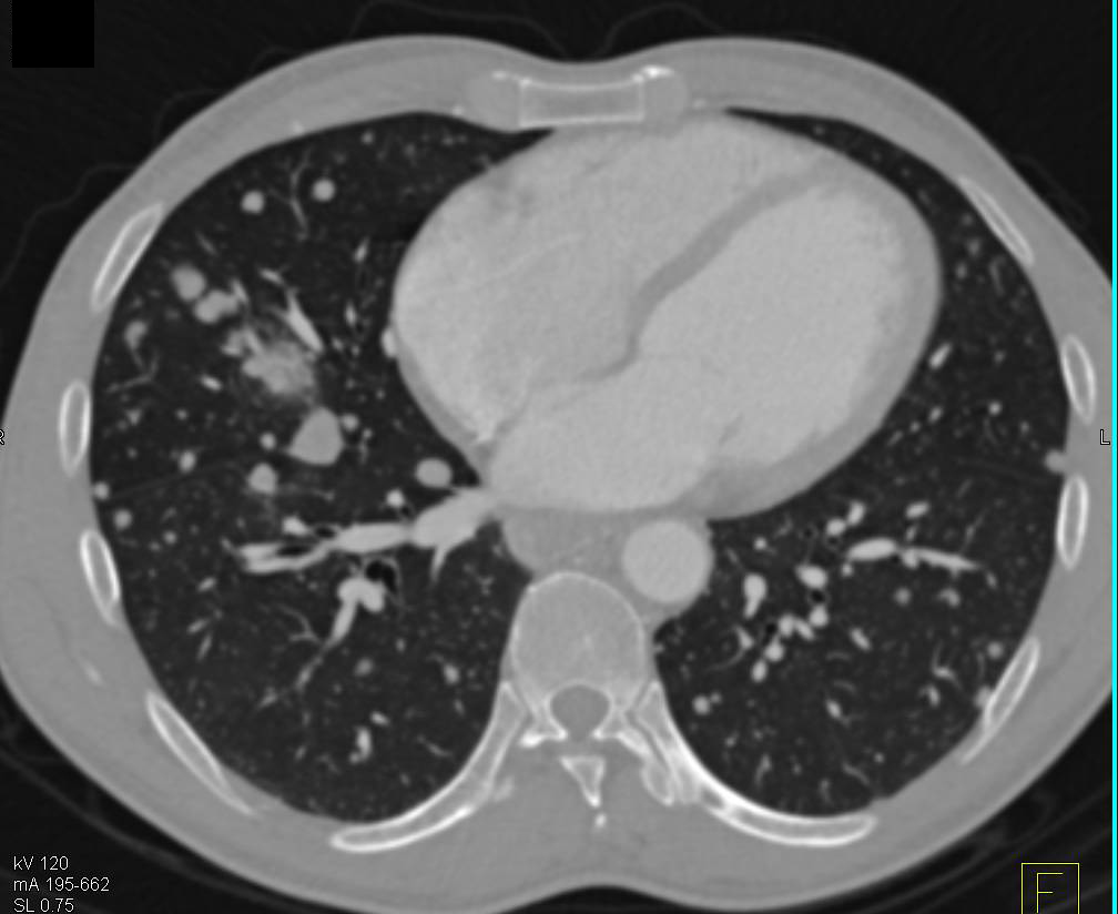 Hepatocellular Carcinoma (Hepatoma) with Neovascularity and Lung Metastases - CTisus CT Scan