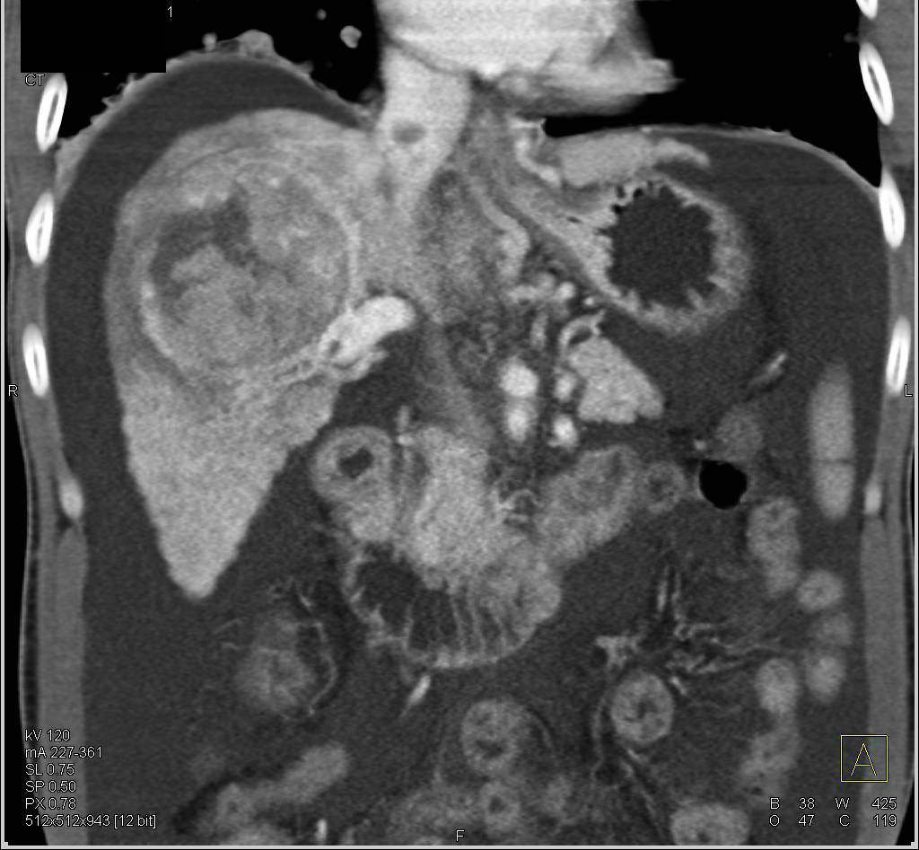 Hepatocellular Carcinoma (Hepatoma) with Extension into Hepatic Veins and Inferior Vena Cava (IVC) - CTisus CT Scan