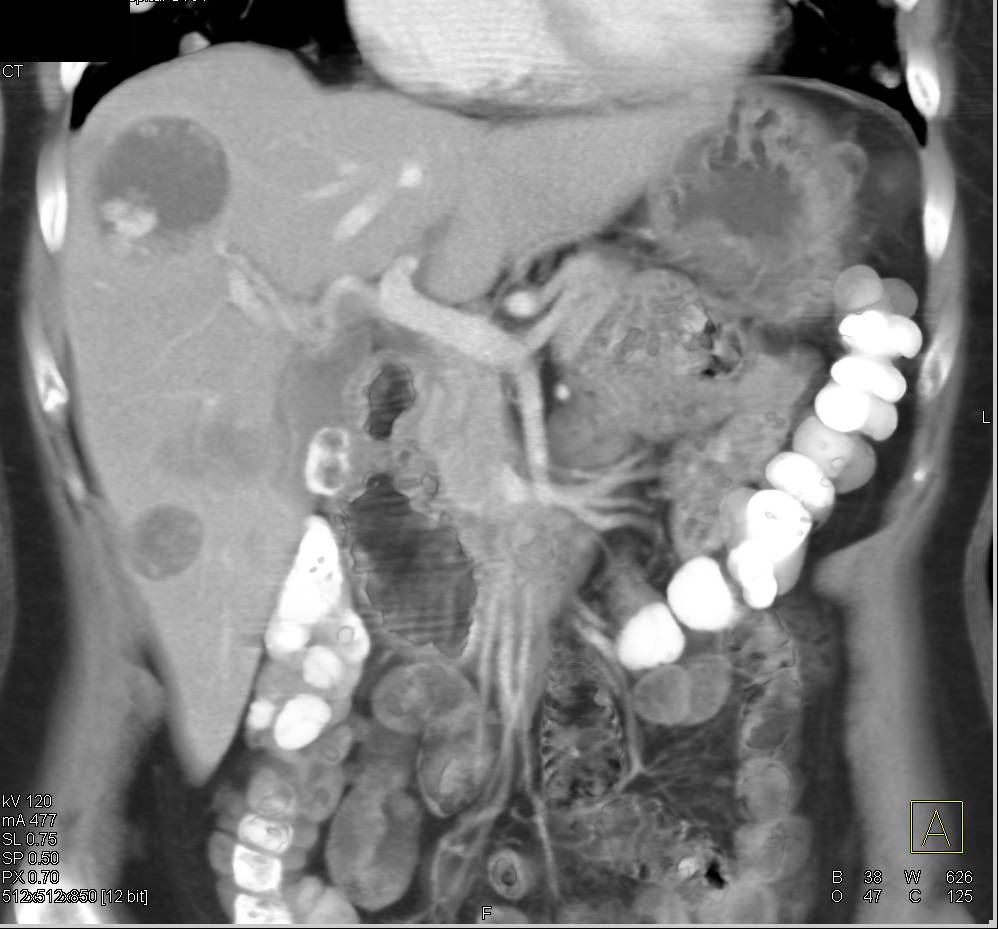 Metastatic Angiosarcoma to Liver and Lungs - CTisus CT Scan
