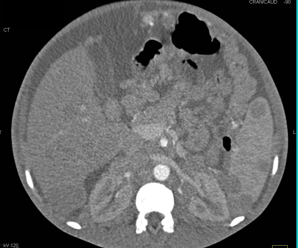 Metastatic Melanoma with Liver and Splenic Metastases and Carcinomatosis - CTisus CT Scan