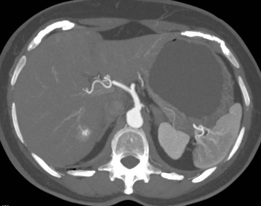 Flash Filling Hemangioma Right Lobe of Liver - CTisus CT Scan