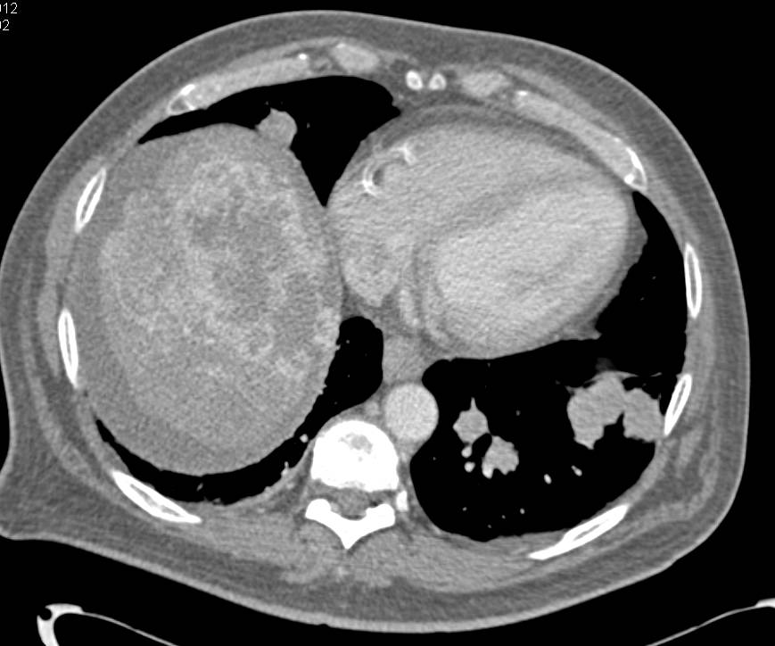 Hepatocellular Carcinoma (Hepatoma) with Lung Metastases - CTisus CT Scan