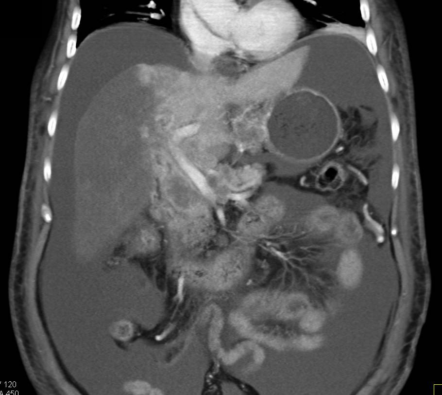 Multifocal Hepatocellular Carcinoma (Hepatoma) with Carcinomatosis - CTisus CT Scan