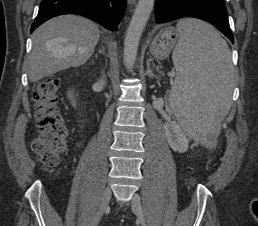 Arteriovenous (AV) Shunting in the Liver - CTisus CT Scan