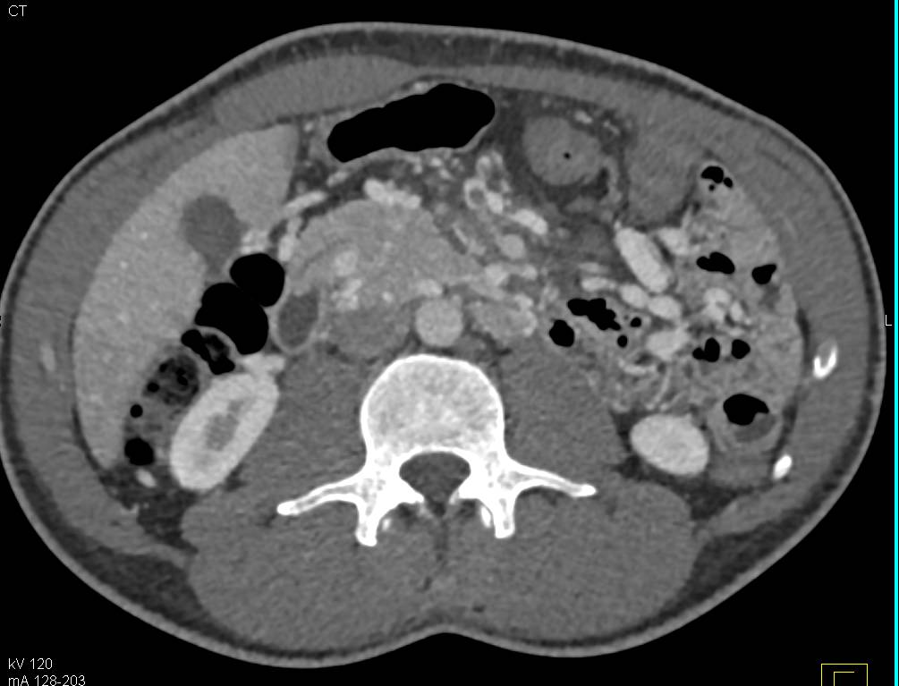 Cavernous Transformation of the Portal Vein - CTisus CT Scan