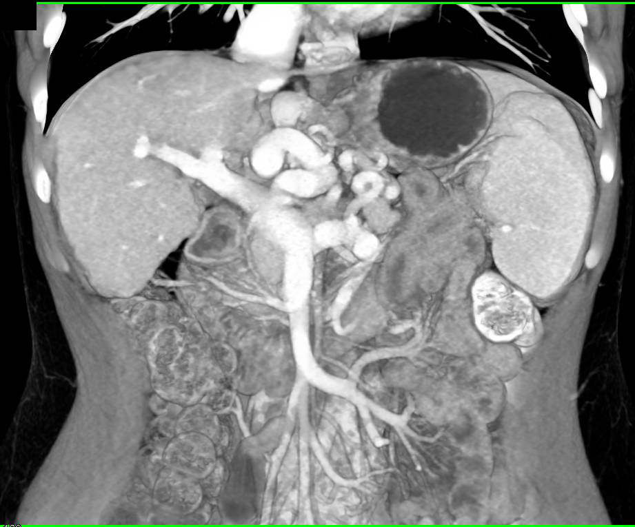 Cavernous Transformation of the Portal Vein - CTisus CT Scan