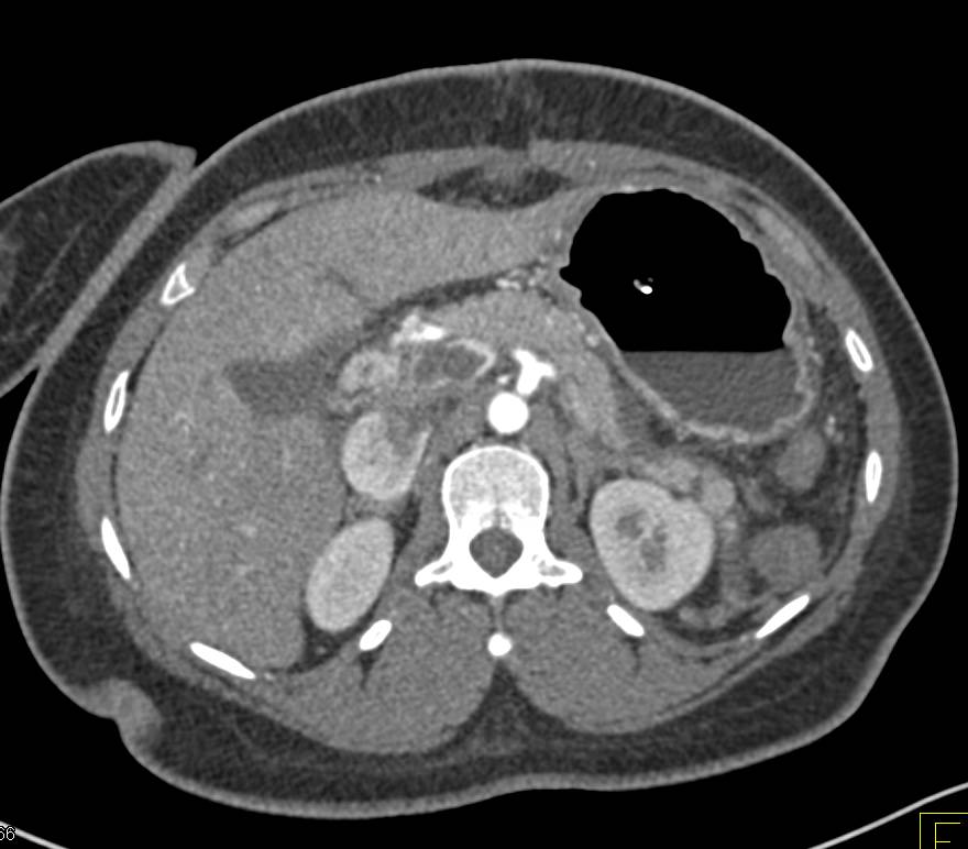 Non-occlusive Portal Vein Thrombosis - CTisus CT Scan