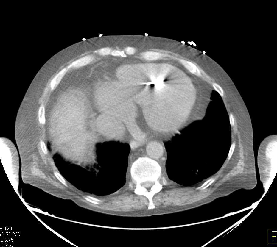 Poor Right Sided Heart Function with Dilated Inferior Vena Cava (IVC) and Hepatic Veins - CTisus CT Scan