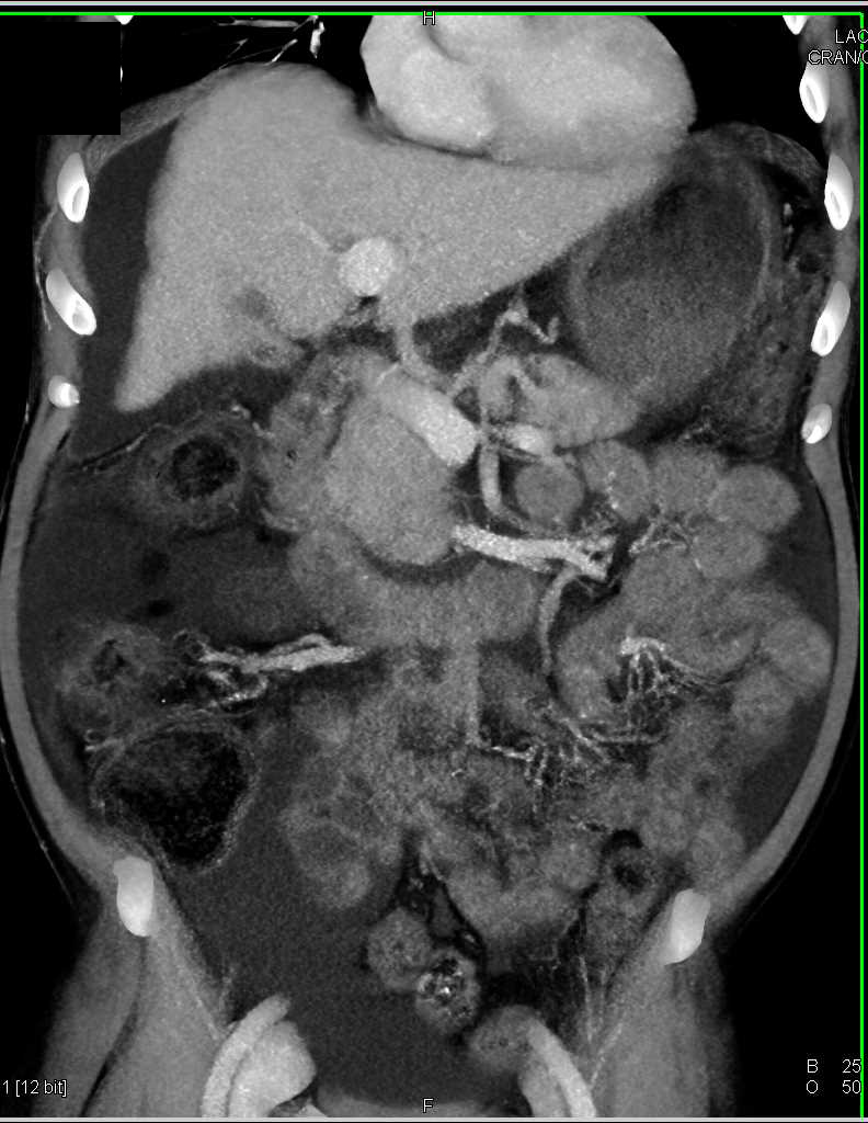 Cirrhosis with Portal Hypertension with Large Umbilical Veins - CTisus CT Scan