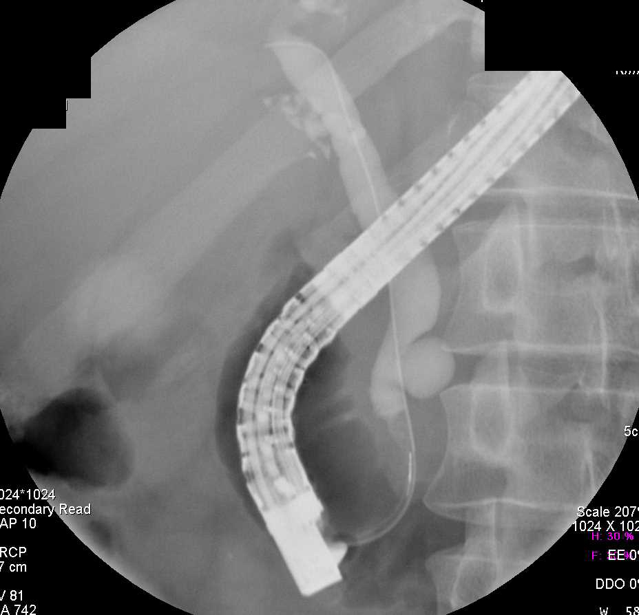 Choledochal Cyst - CTisus CT Scan