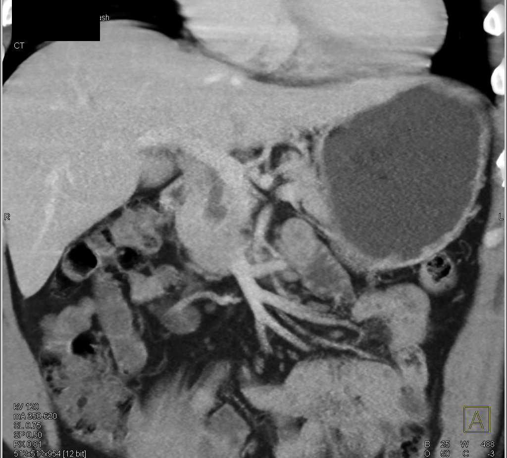Choledochal Cyst - CTisus CT Scan