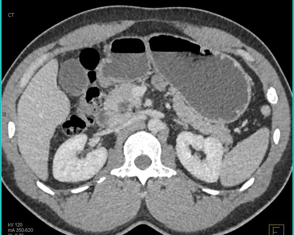Choledochal Cyst - CTisus CT Scan