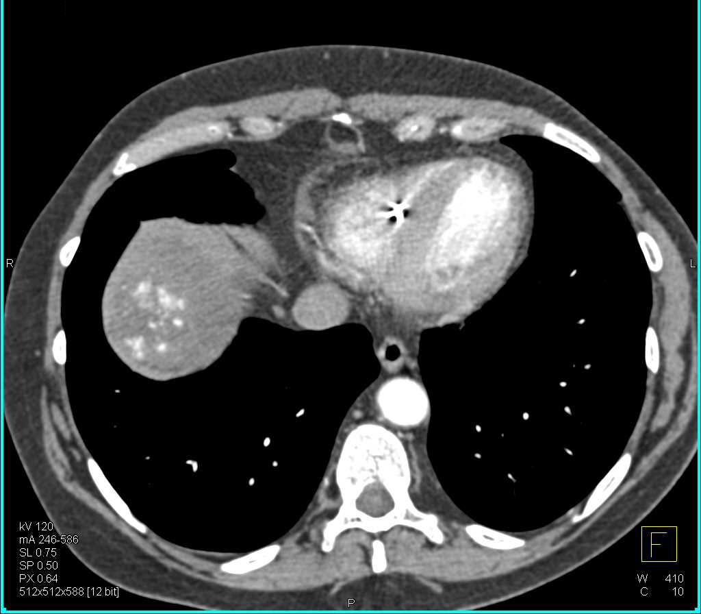Hepatic Hemangioma Simulates a Malignancy - CTisus CT Scan