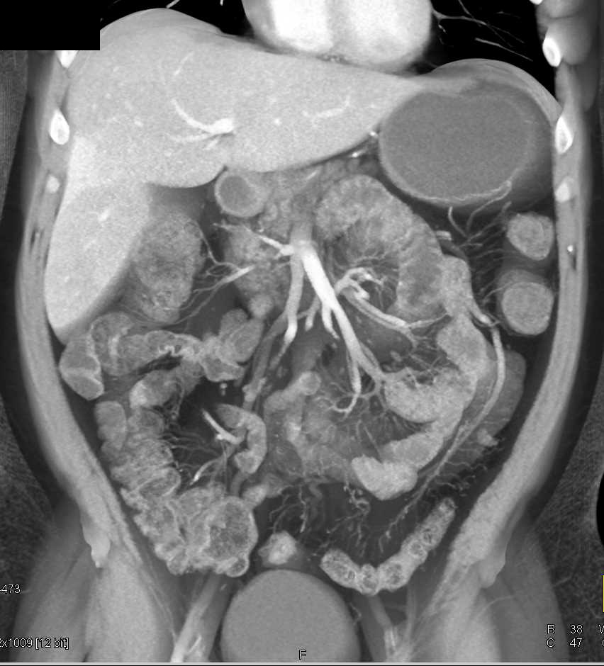 Fatty Liver with Areas of Sparing and Liver Metastases - CTisus CT Scan