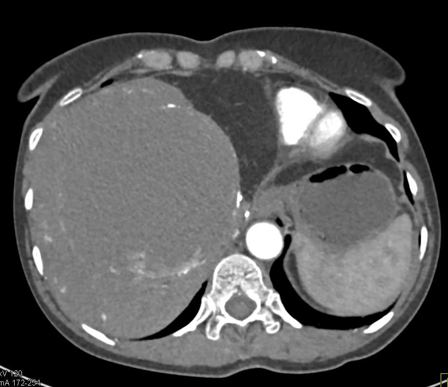 Giant Cavernous Hemangioma of the Liver - CTisus CT Scan
