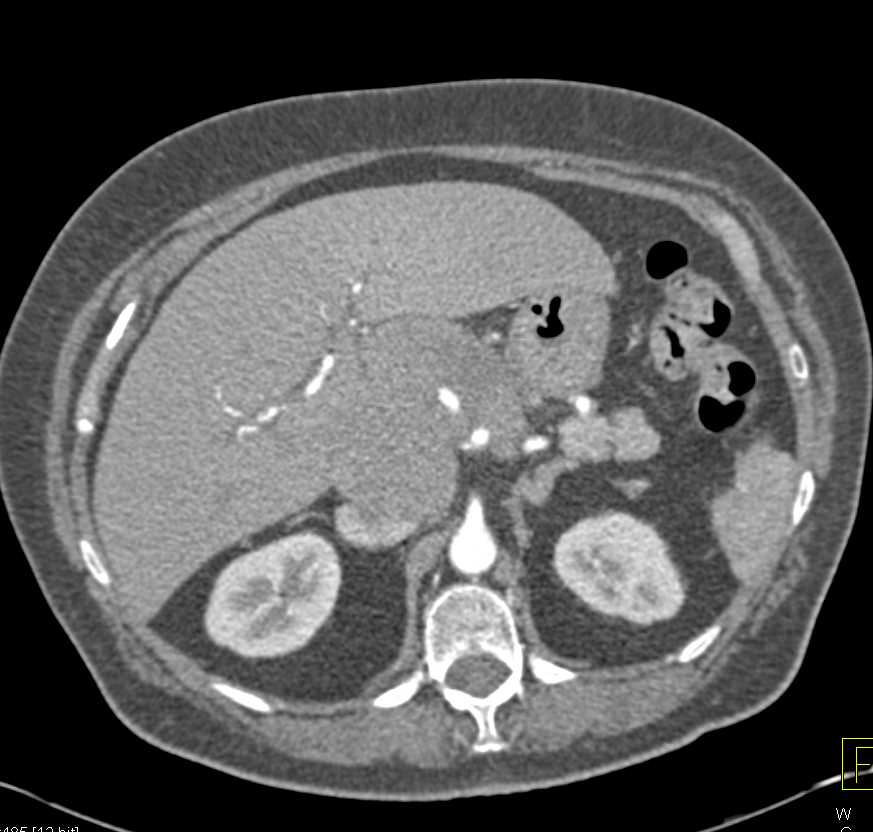 Cholangiocarcinoma with Nodes Near Hilum of the Liver - CTisus CT Scan