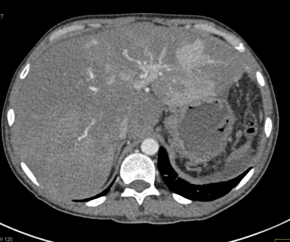 Budd-Chiari Syndrome with Patchy Enhancement of the Liver - CTisus CT Scan