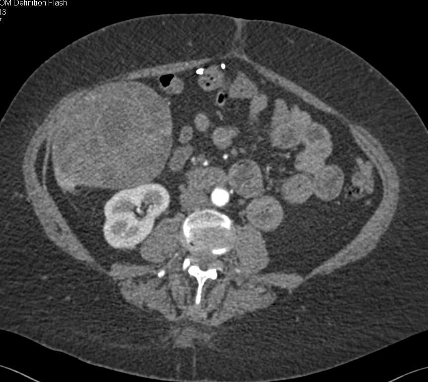 Gallbladder Cancer - CTisus CT Scan