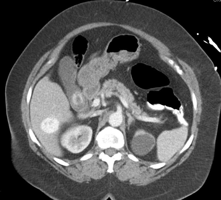 Focal Nodular Hyperplasia Liver - CTisus CT Scan