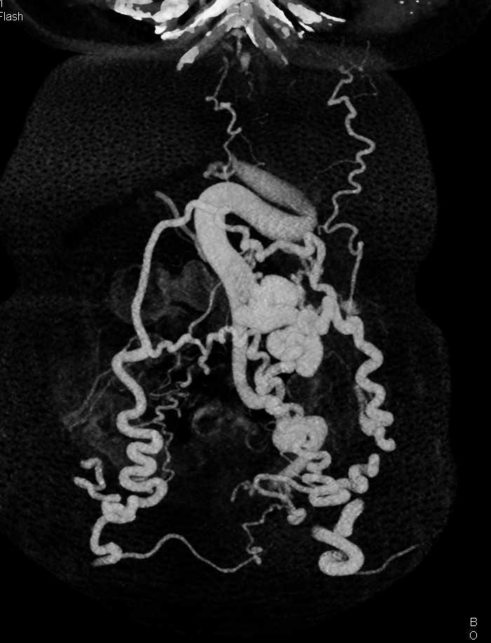 Recanalized Umbilical Vein and Huge Abdominal Wall Varices - CTisus CT Scan