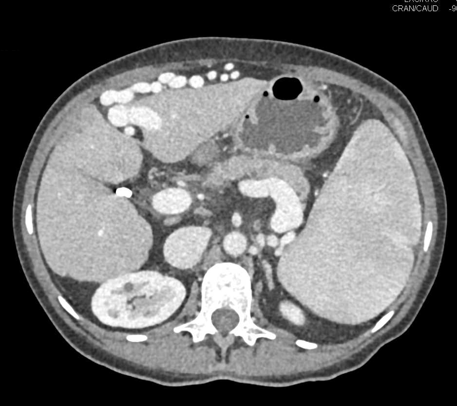 Cirrhosis with Portal Hypertension and Huge Varices - CTisus CT Scan