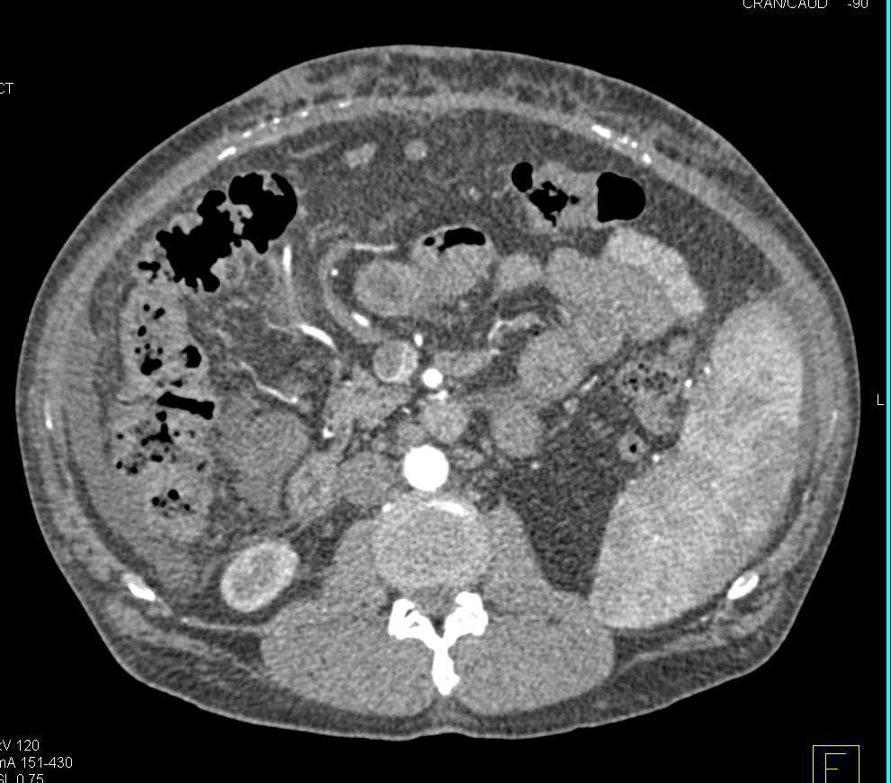 Cirrhosis with Portal Hypertension and Thrombus in the Portal Vein - CTisus CT Scan