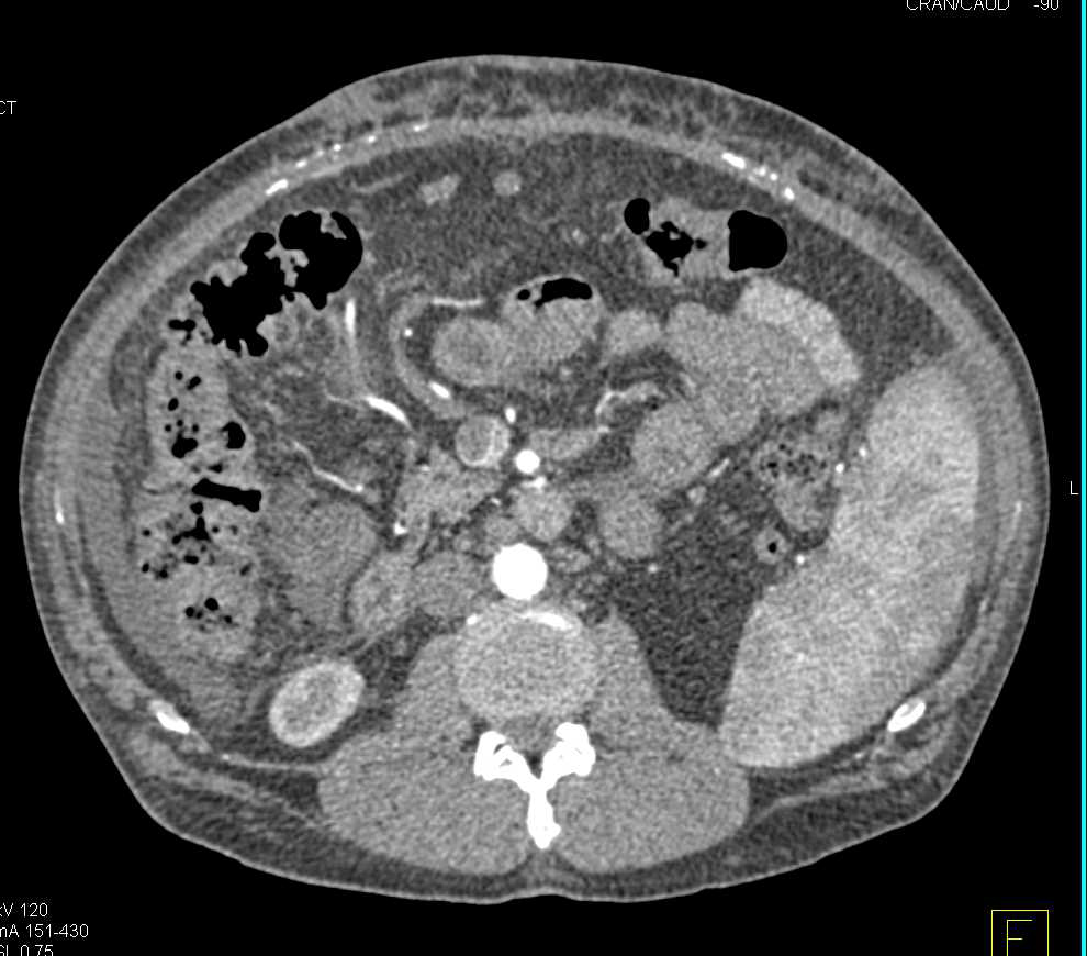 Cirrhosis with Portal Hypertension and Thrombus in the Portal Vein - CTisus CT Scan