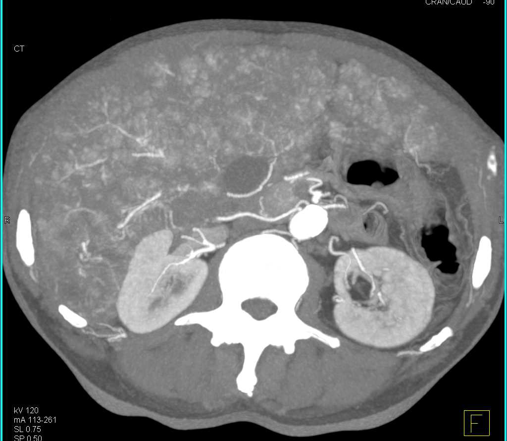 Metastatic Neuroendocrine Tumor to the Liver with Dual Phase Scanning - CTisus CT Scan