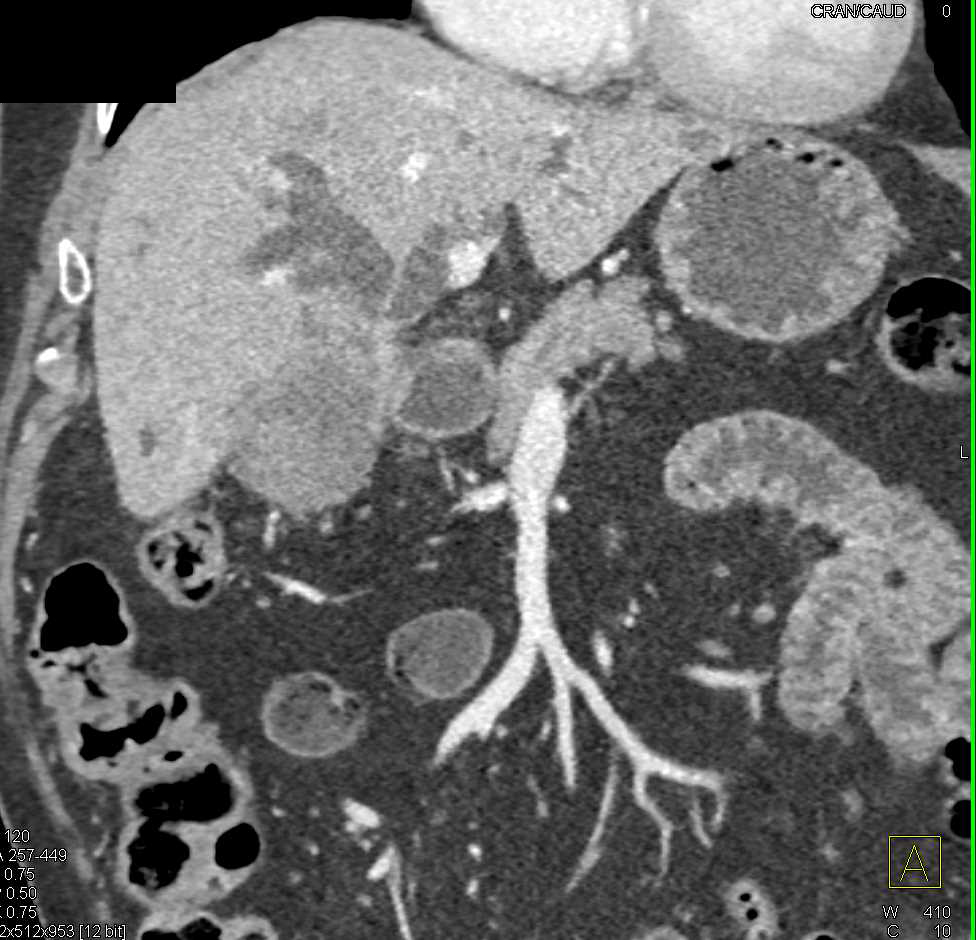 Gallbladder Cancer Extends to Hilum and Obstructs the Common Bile Duct - CTisus CT Scan