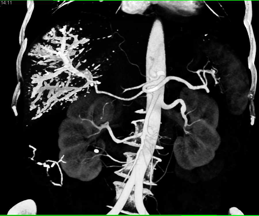 Portal Vein Embolization with Lipiodol - CTisus CT Scan