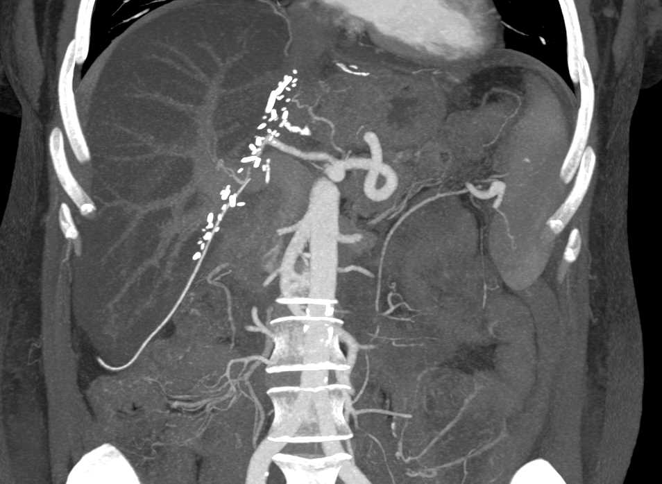 Surgical Staples Following Hepatic Resection - CTisus CT Scan