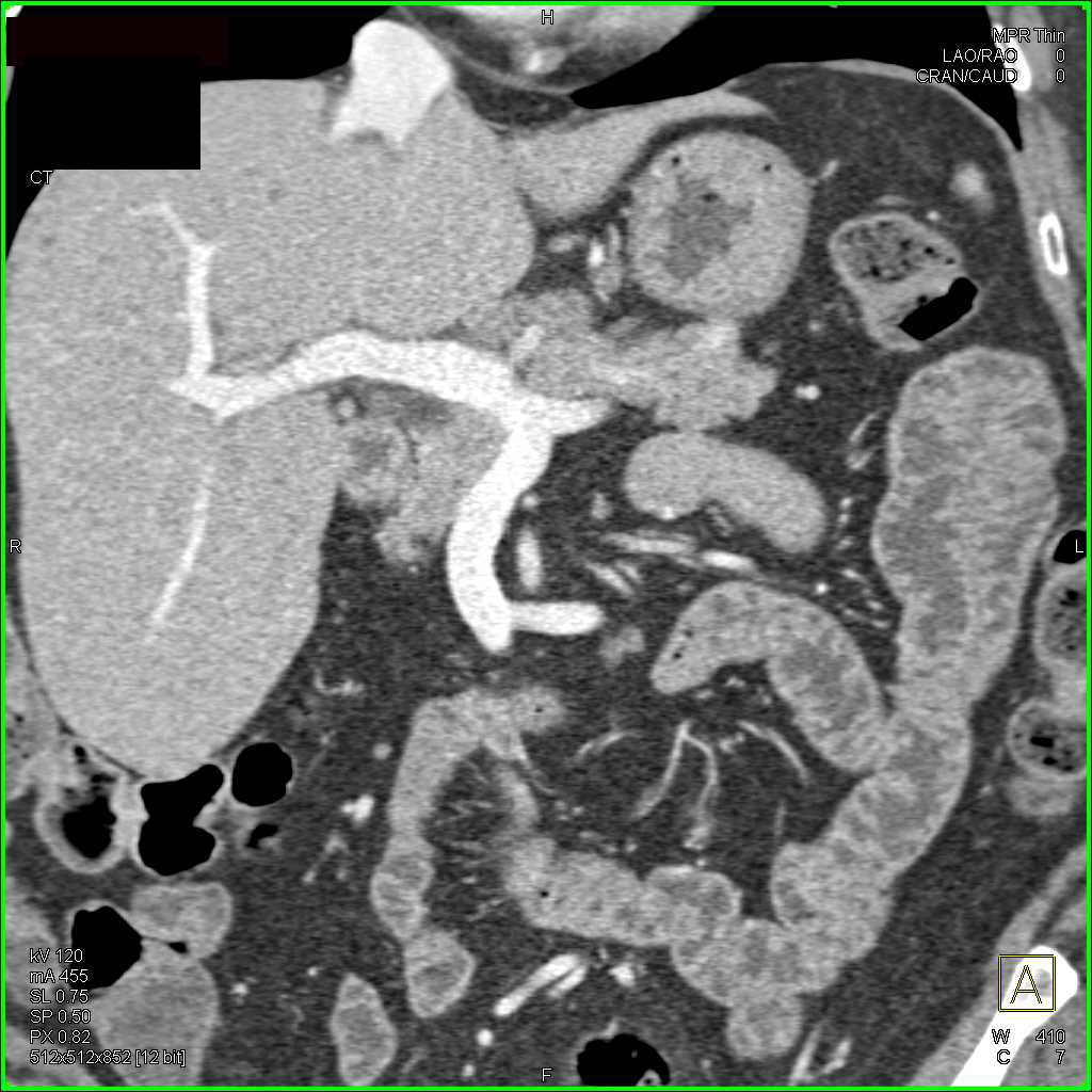 Multiple Nodes in the Porta Hepatis - CTisus CT Scan