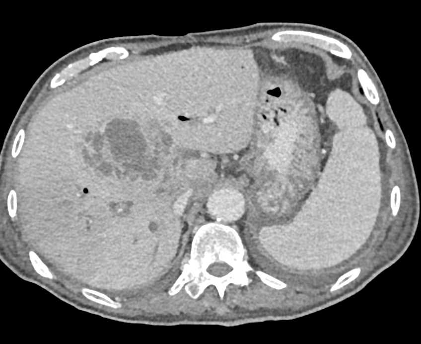 Hepatic Abscess in Patient With a Cholangiocarcinoma - CTisus CT Scan