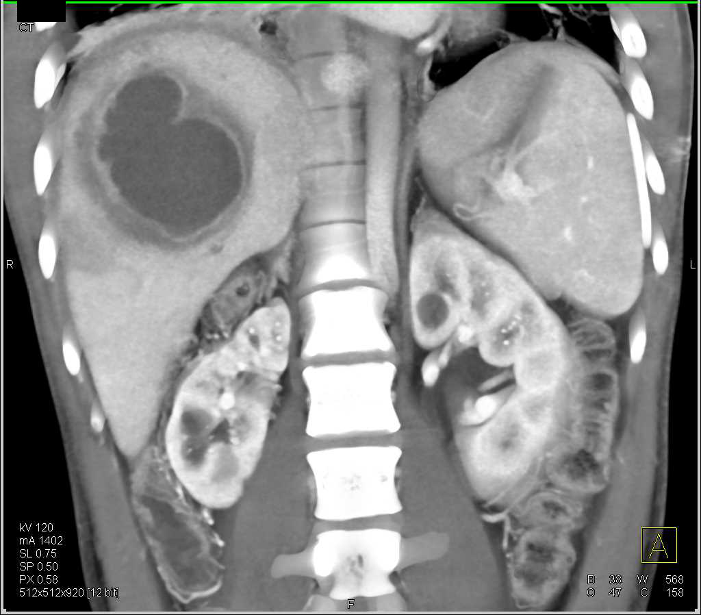 Liver Abscess Liver Case Studies Ctisus Ct Scanning