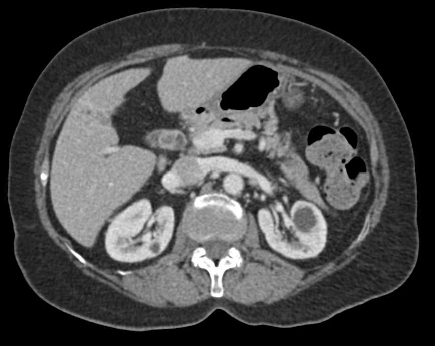 Stone in Common Bile Duct with Cholangitis - CTisus CT Scan
