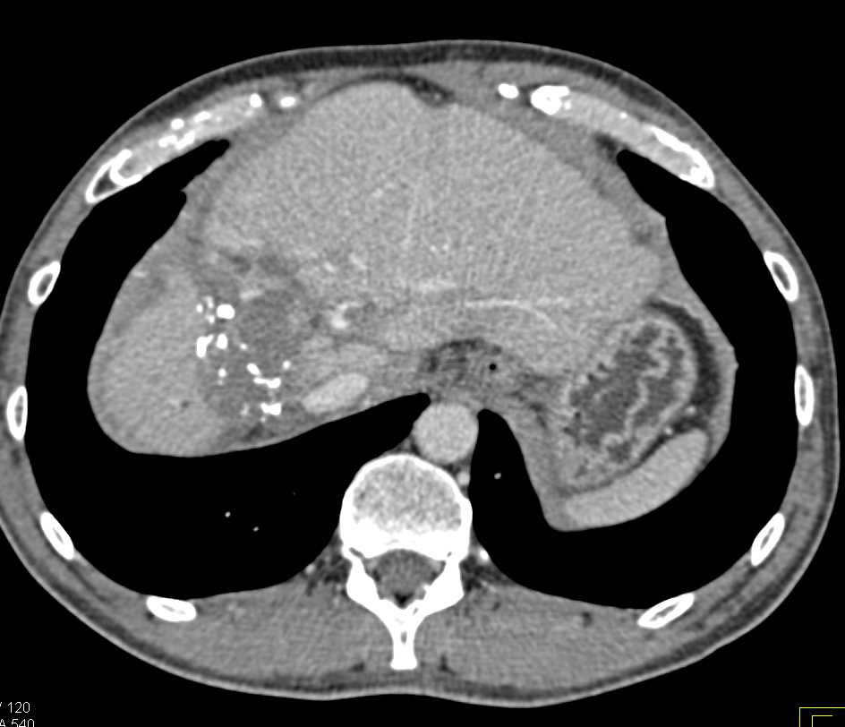Recurrent Hepatocellular Carcinoma (Hepatoma) at Resection Site - CTisus CT Scan