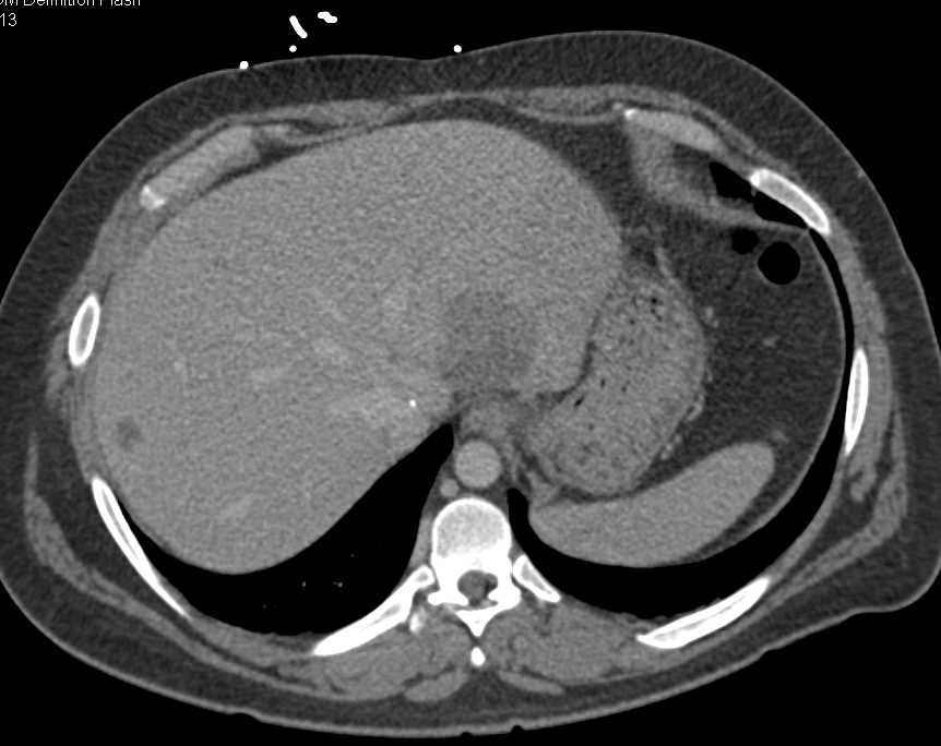 Liver Metastases from Colon Cancer - CTisus CT Scan