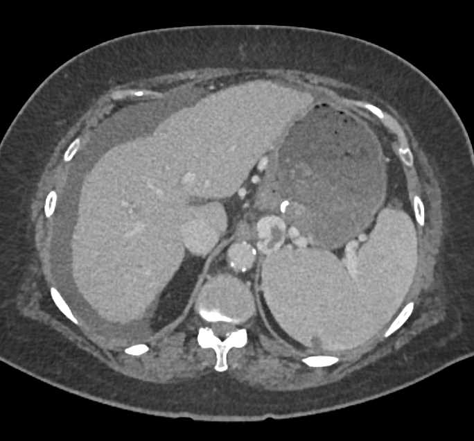 Huge Gastric Varices and Clot in the Portal Vein - CTisus CT Scan