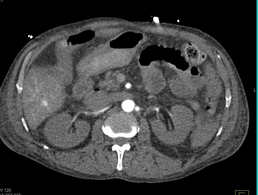 Dilated Inferior Vena Cava (IVC) with Poor Cardiac and Renal Function - CTisus CT Scan